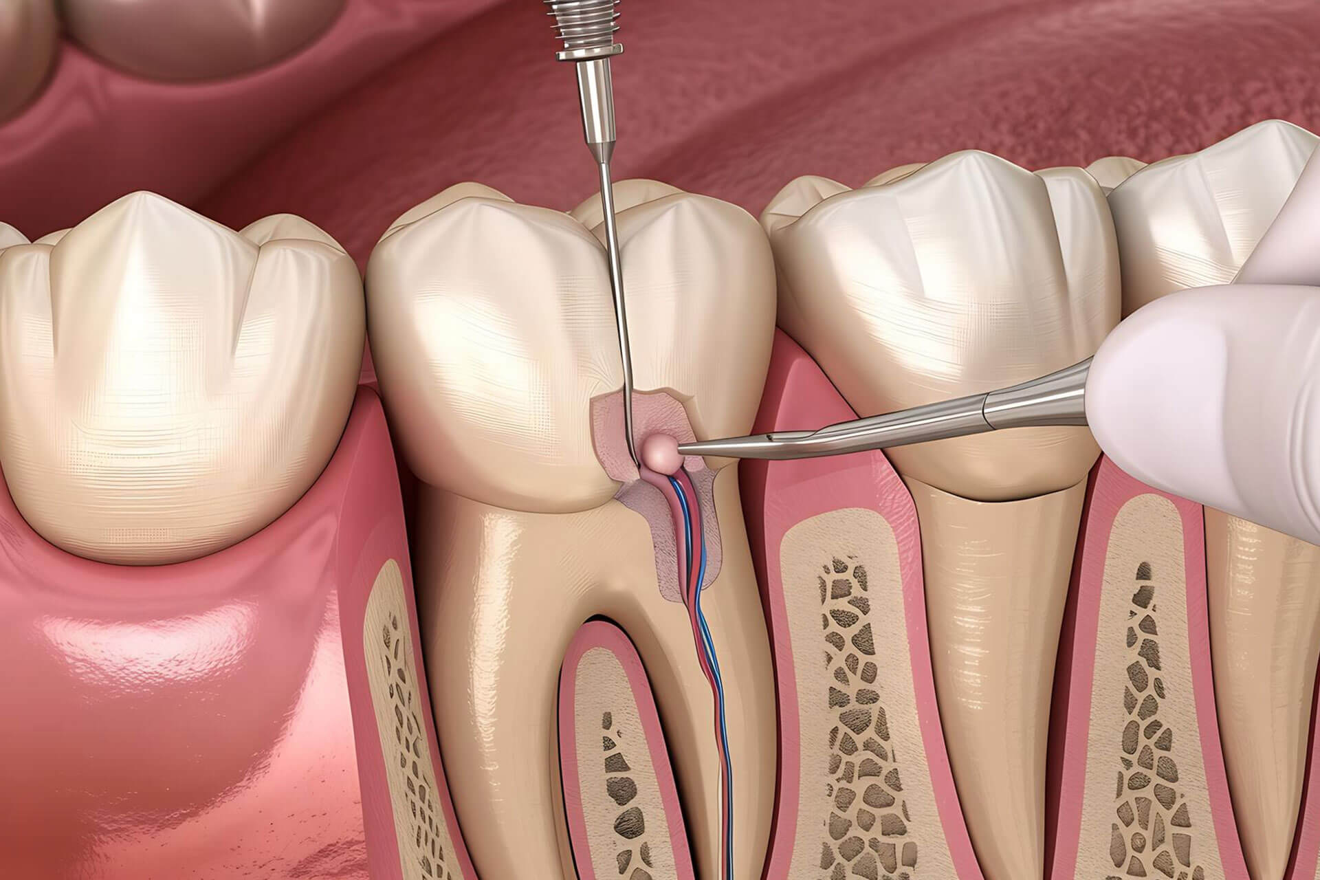 Ab-Dental-Endodoncija Endodoncija