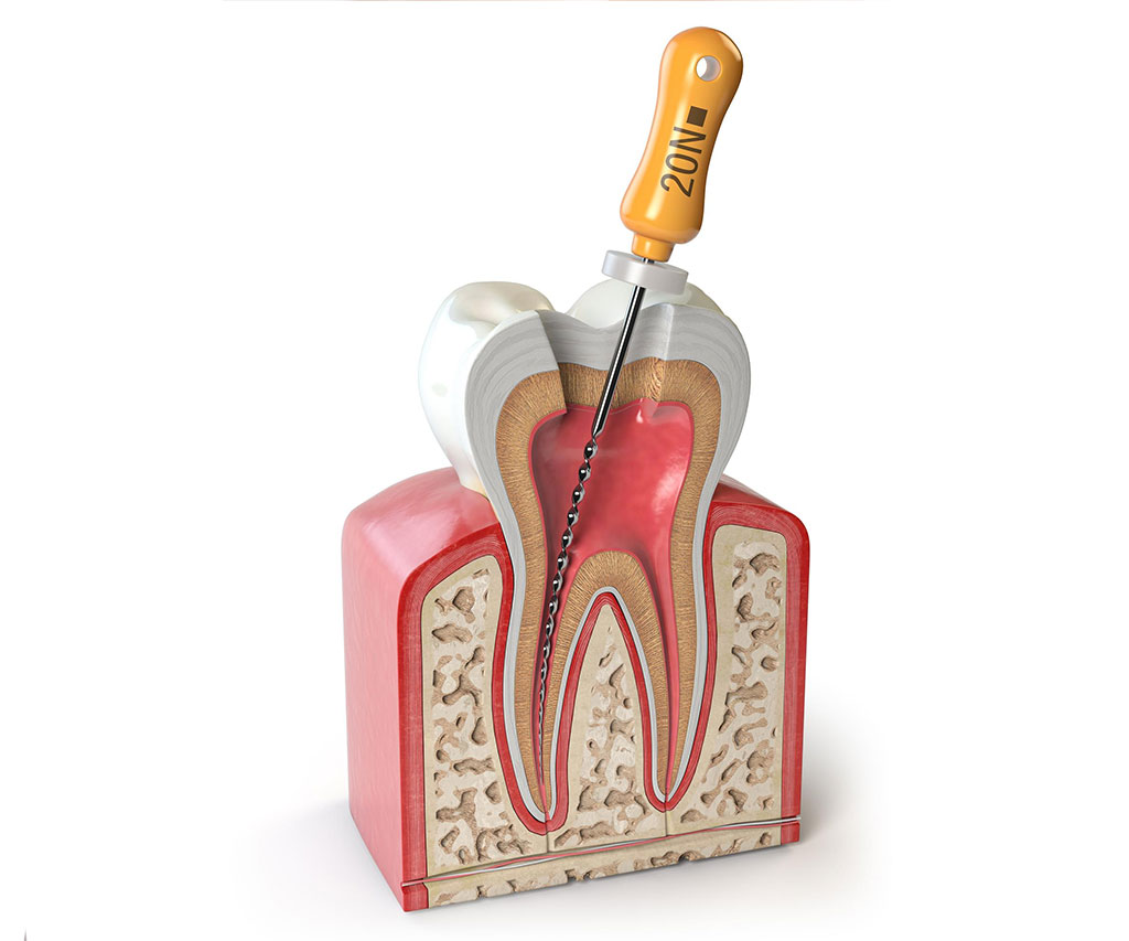 Endodoncija 2 Ab Dental Endodoncija2