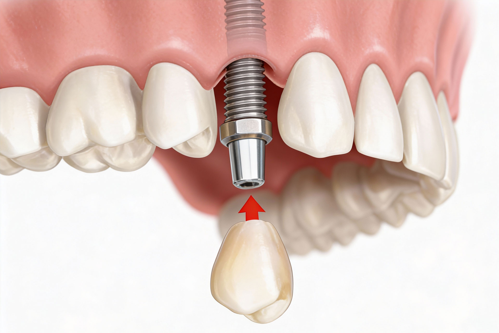 Ab-Dental-Implantologija Ab Dental Implantologija