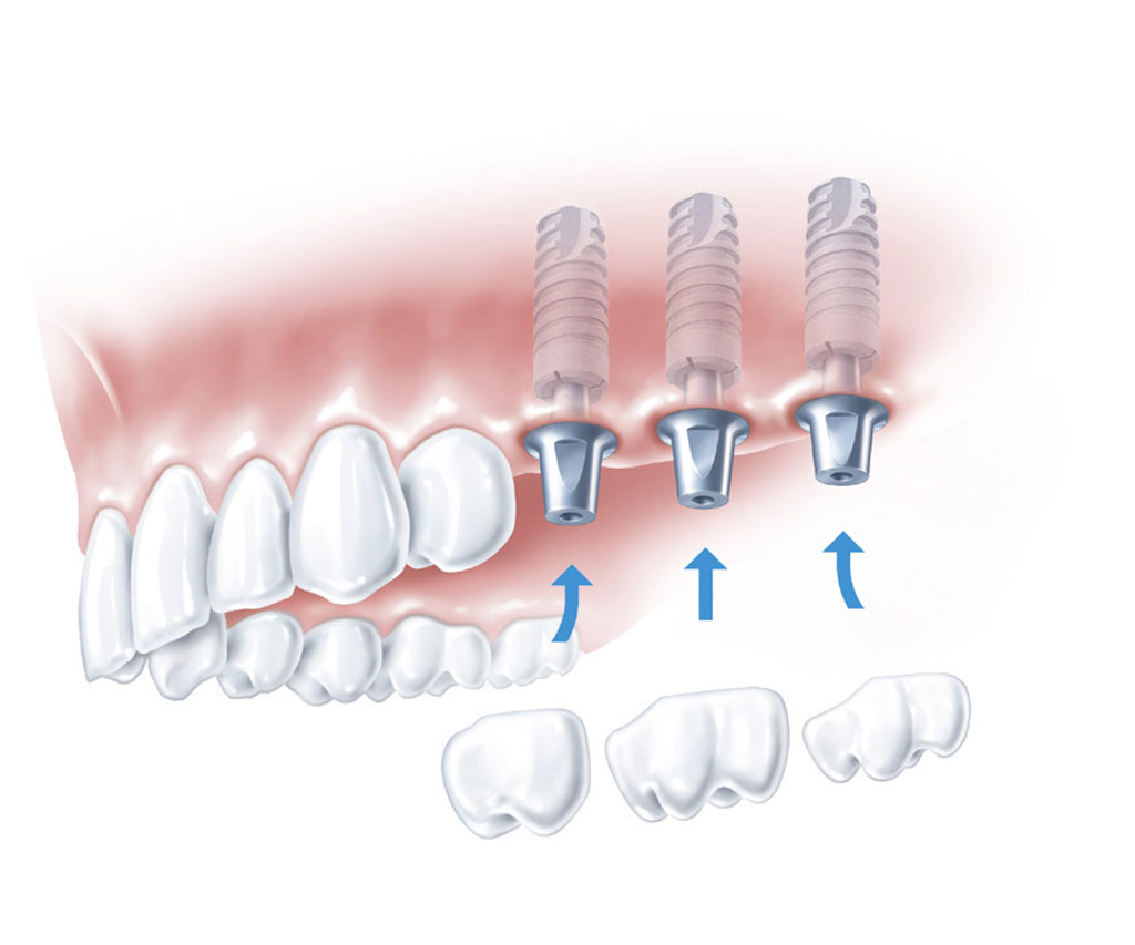 Implantologija 1 Ab Dental Implantologija1