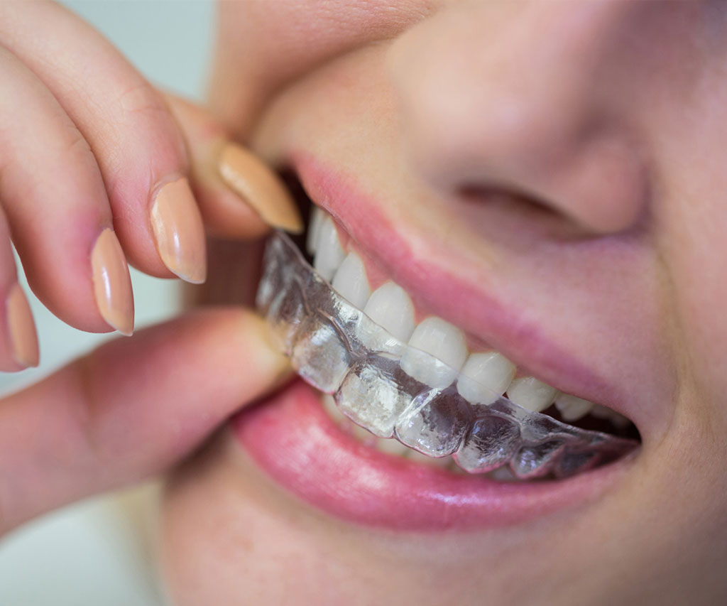 Izbeljivanje zuba 2 Ab Dental Izbeljivanje zuba1