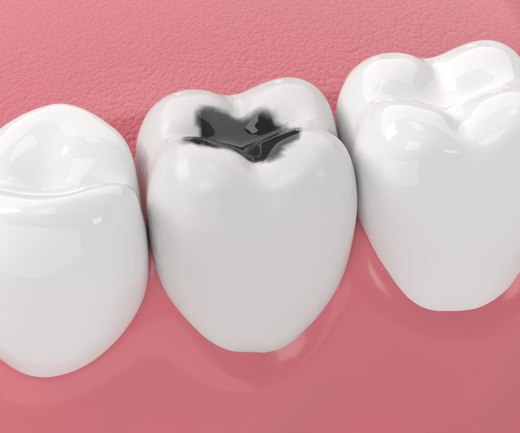 Opšta stomatologija 1 Ab Dental Opsta stomatologija karijes